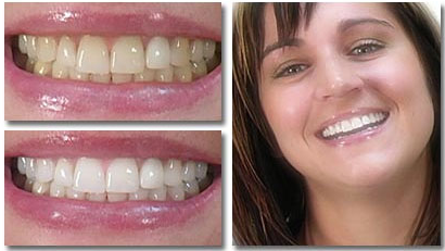 Before After Whitening Treatment