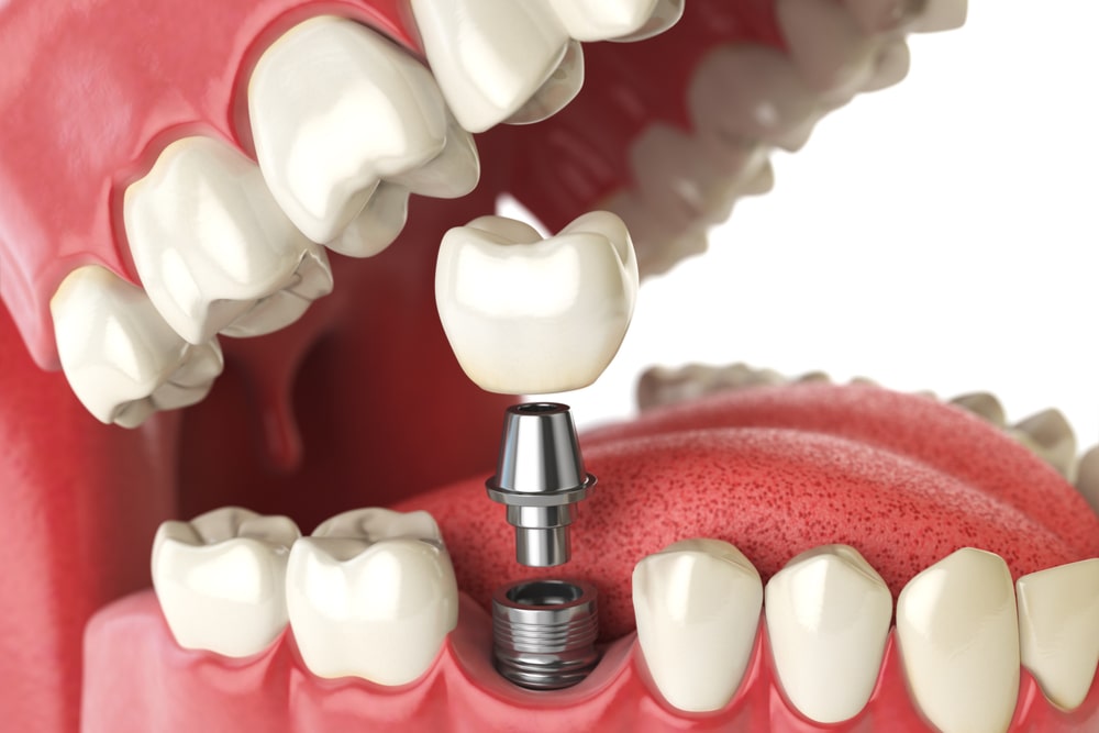 Tooth human implant